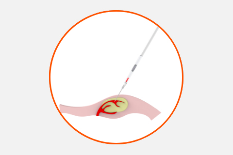 EzVu™ - Visual Vasopressor Injector